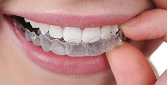 Self-Ligating Braces: What You Need To Know – Forbes Health