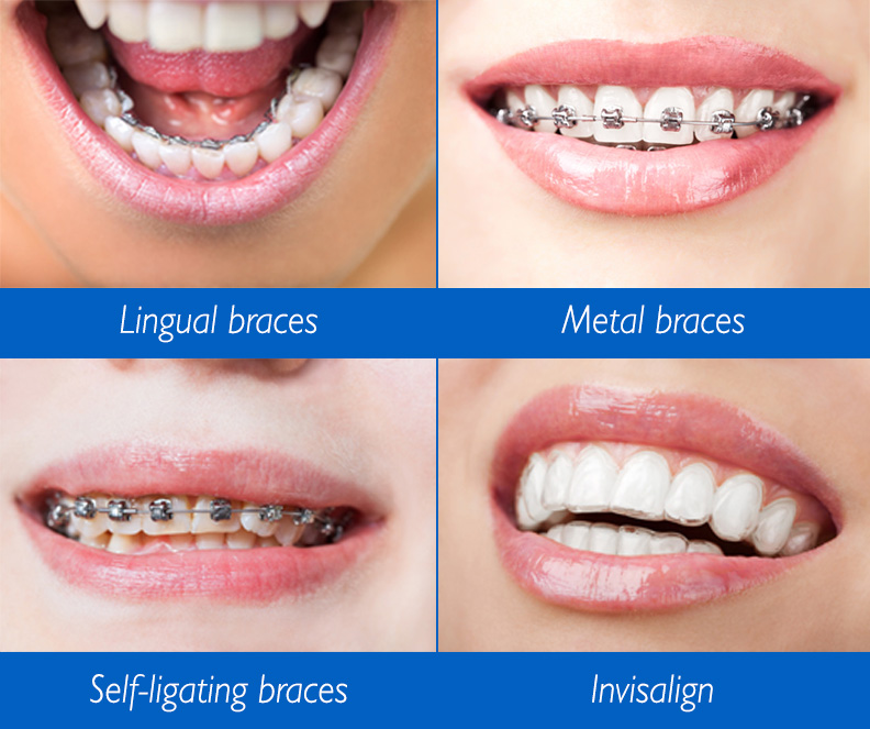 Lingual Braces: Pros and Cons, Cost, Comfort, Lisping, and More
