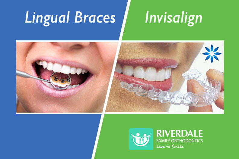 Invisalign vs Braces – We reveal the truth about how they compare